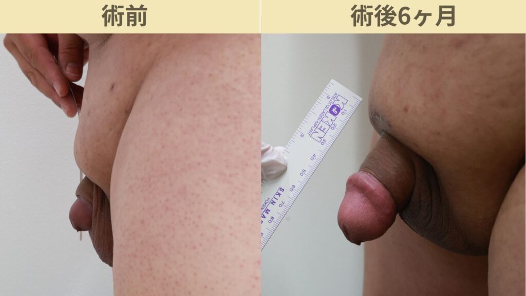 【症例9】30代男性 |アルモ式バック筋膜切開(靭帯剥離併用あり)+傷跡修正で長茎11mm延長術後6ヶ月2