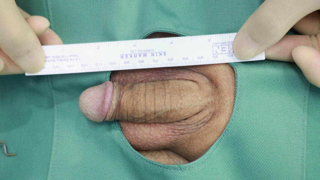 【症例34】50代男性 ｜アルモ式バック筋膜切開（靭帯剥離併用あり）＋包茎で長茎25ｍｍ延長術前