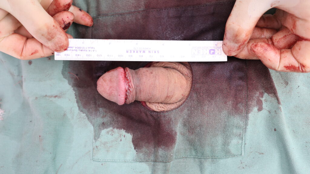 【症例25】40代男性 |アルモ式バック筋膜切開(靭帯剥離併用あり)で長茎1cm延長術後
