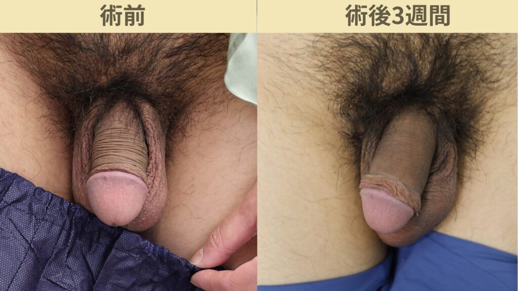 陰茎増大治療症例6術後3週間