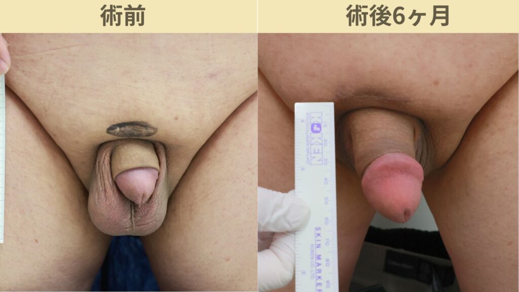 バック筋膜切開・靭帯剥離・傷跡修正・腹部傷跡修正術後6ヶ月1