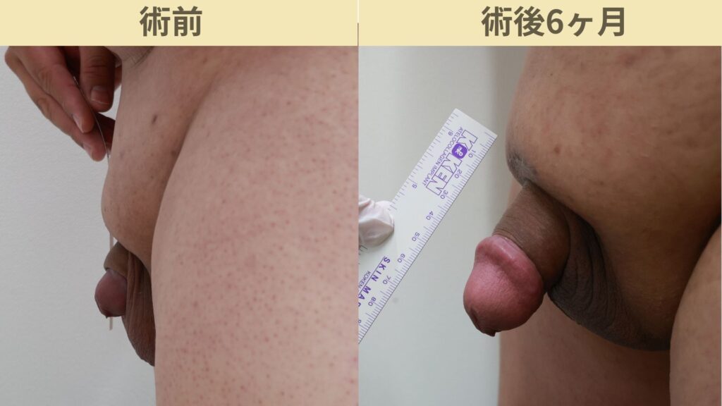 バック筋膜切開・靭帯剥離・傷跡修正・腹部傷跡修正術後6ヶ月2