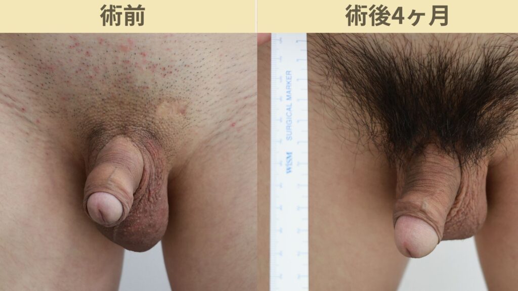 【症例29】20代男性 |アルモ式バック筋膜切開(靭帯剥離併用あり)+包皮切除+亀頭ぶつぶつ除去で長茎22mm延長術後4ヶ月