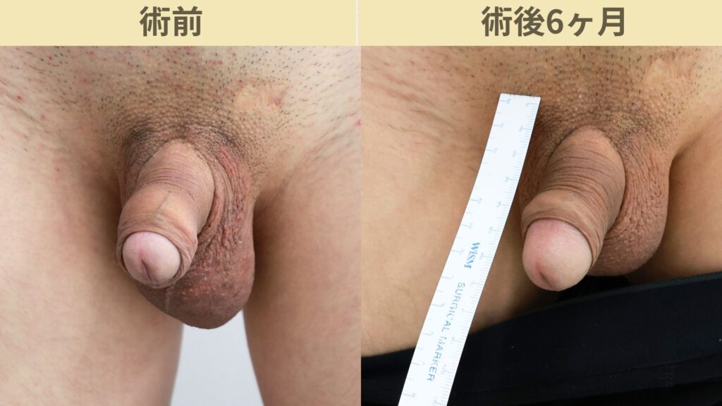 【症例29】20代男性 |アルモ式バック筋膜切開(靭帯剥離併用あり)+包皮切除+亀頭ぶつぶつ除去で長茎22mm延長術後6ヶ月