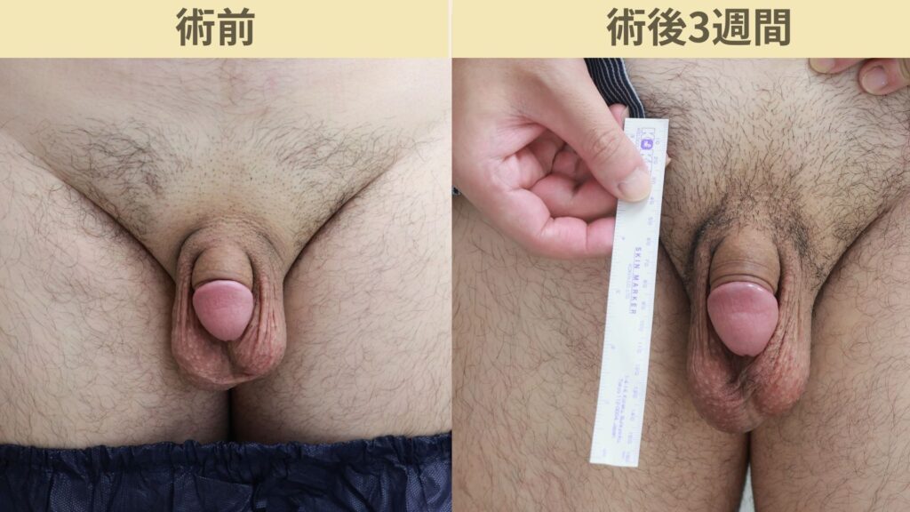 【症例31】30代男性 ｜アルモ式バック筋膜切開（靭帯剥離併用あり）＋包皮切除＋他院術後瘢痕修正術で長茎25ｍｍ延長術後3週間3