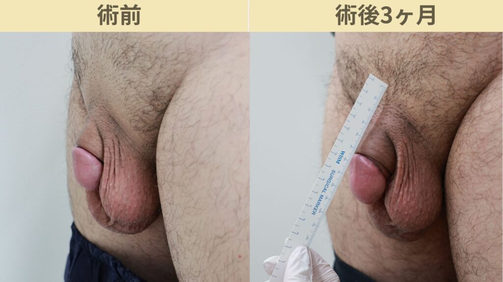 【症例31】30代男性 ｜アルモ式バック筋膜切開（靭帯剥離併用あり）＋包皮切除＋他院術後瘢痕修正術で長茎25ｍｍ延長術後3ヶ月