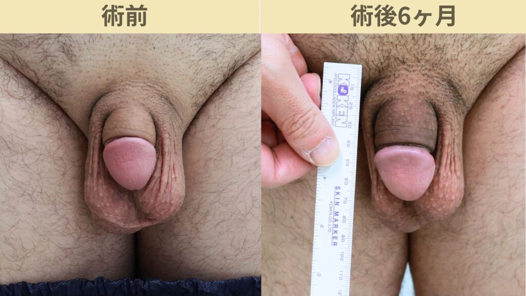 【症例31】30代男性 ｜アルモ式バック筋膜切開（靭帯剥離併用あり）＋包皮切除＋他院術後瘢痕修正術で長茎25ｍｍ延長術後6ヶ月