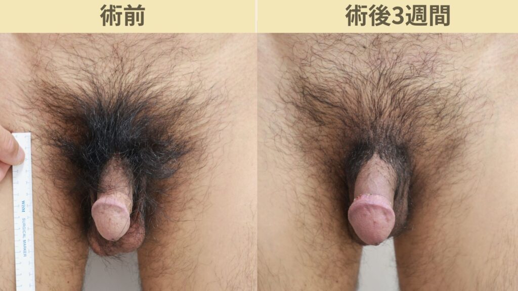 【症例32】40代男性 ｜アルモ式バック筋膜切開（靭帯剥離併用あり）＋包皮切除＋他院修正で長茎20ｍｍ延長術後3週間3