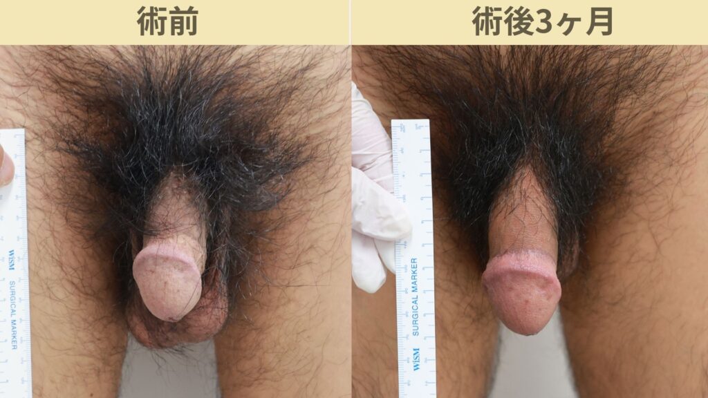 【症例32】40代男性 ｜アルモ式バック筋膜切開（靭帯剥離併用あり）＋包皮切除＋他院修正で長茎20ｍｍ延長術後3ヶ月