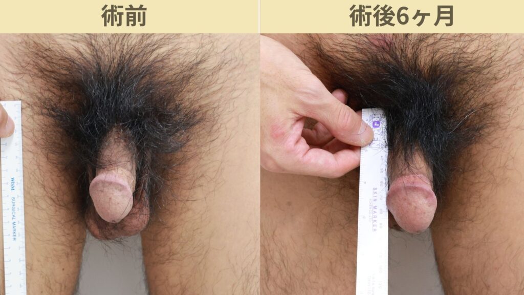 【症例32】40代男性 ｜アルモ式バック筋膜切開（靭帯剥離併用あり）＋包皮切除＋他院修正で長茎20ｍｍ延長術後6ヶ月