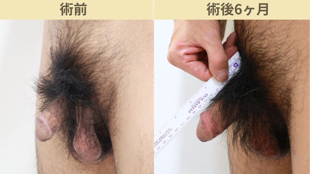 【症例32】40代男性 ｜アルモ式バック筋膜切開（靭帯剥離併用あり）＋包皮切除＋他院修正で長茎20ｍｍ延長術後6ヶ月2