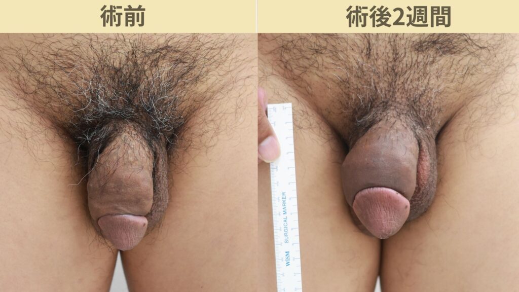 【症例33】30代男性 ｜アルモ式バック筋膜切開（靭帯剥離併用あり）＋他院修正で長茎12ｍｍ延長術後2週間3