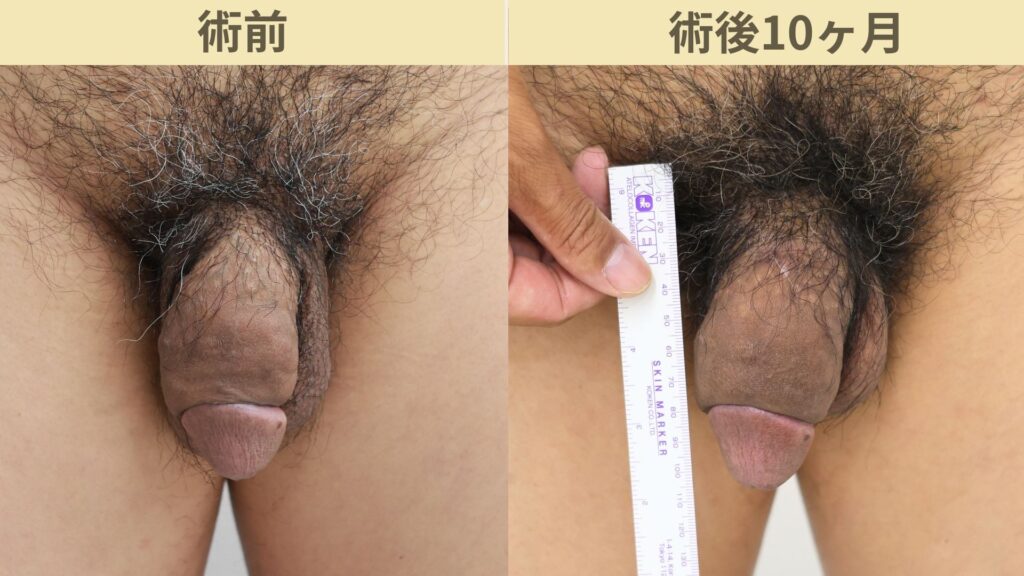 【症例33】30代男性 ｜アルモ式バック筋膜切開（靭帯剥離併用あり）＋他院修正で長茎12ｍｍ延長術後10ヶ月