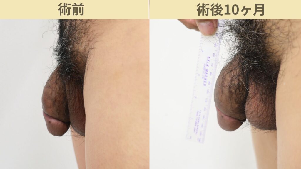 【症例33】30代男性 ｜アルモ式バック筋膜切開（靭帯剥離併用あり）＋他院修正で長茎12ｍｍ延長術後10ヶ月2