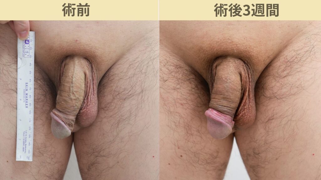【症例34】50代男性 ｜アルモ式バック筋膜切開（靭帯剥離併用あり）＋包茎で長茎25ｍｍ延長術後3週間3