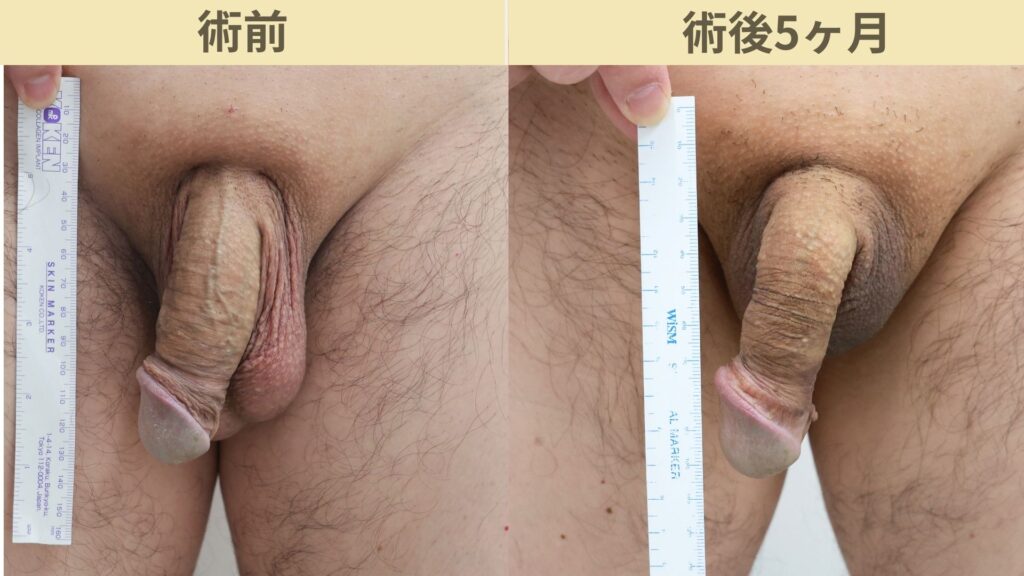 【症例34】50代男性 ｜アルモ式バック筋膜切開（靭帯剥離併用あり）＋包茎で長茎25ｍｍ延長術後5ヶ月