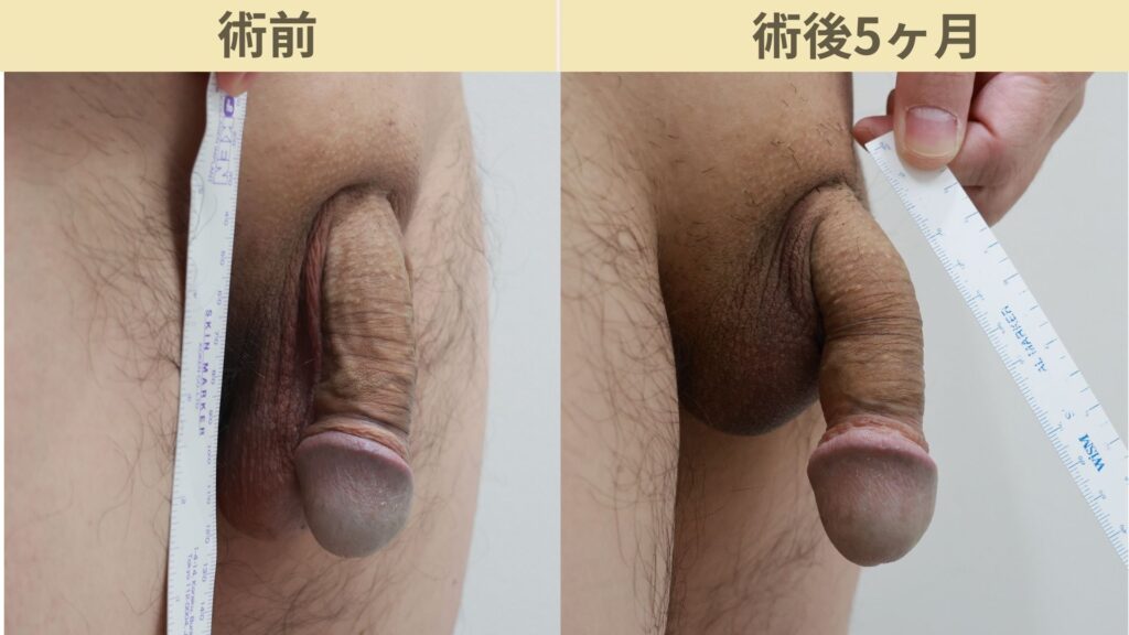 【症例34】50代男性 ｜アルモ式バック筋膜切開（靭帯剥離併用あり）＋包茎で長茎25ｍｍ延長術後5ヶ月2