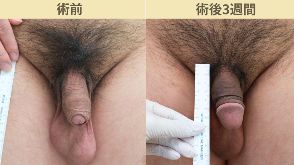 【症例37】20代男性 ｜アルモ式バック筋膜切開（靭帯剥離併用あり）＋包茎で長茎17ｍｍ延長術後3週間3