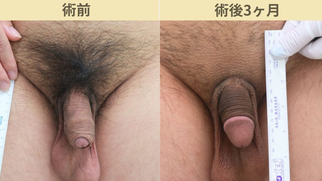 【症例37】20代男性 ｜アルモ式バック筋膜切開（靭帯剥離併用あり）＋包茎で長茎17ｍｍ延長術後3ヶ月