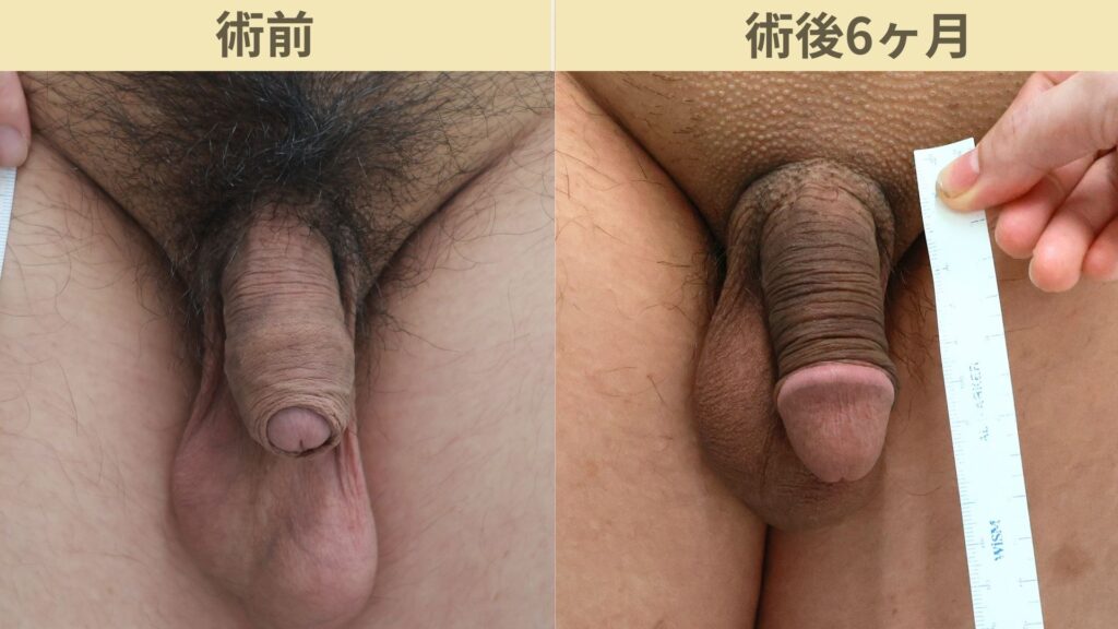 【症例37】20代男性 ｜アルモ式バック筋膜切開（靭帯剥離併用あり）＋包茎で長茎17ｍｍ延長術後6ヶ月