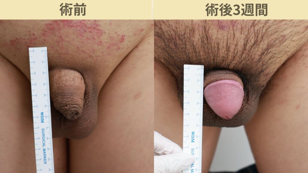 【症例38】30代男性 ｜アルモ式バック筋膜切開（靭帯剥離併用あり）＋包茎で長茎15ｍｍ延長術後3週間3