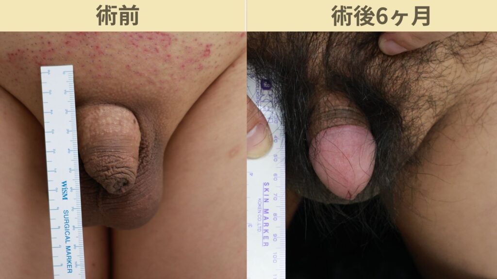 【症例38】30代男性 ｜アルモ式バック筋膜切開（靭帯剥離併用あり）＋包茎で長茎15ｍｍ延長術後6ヶ月