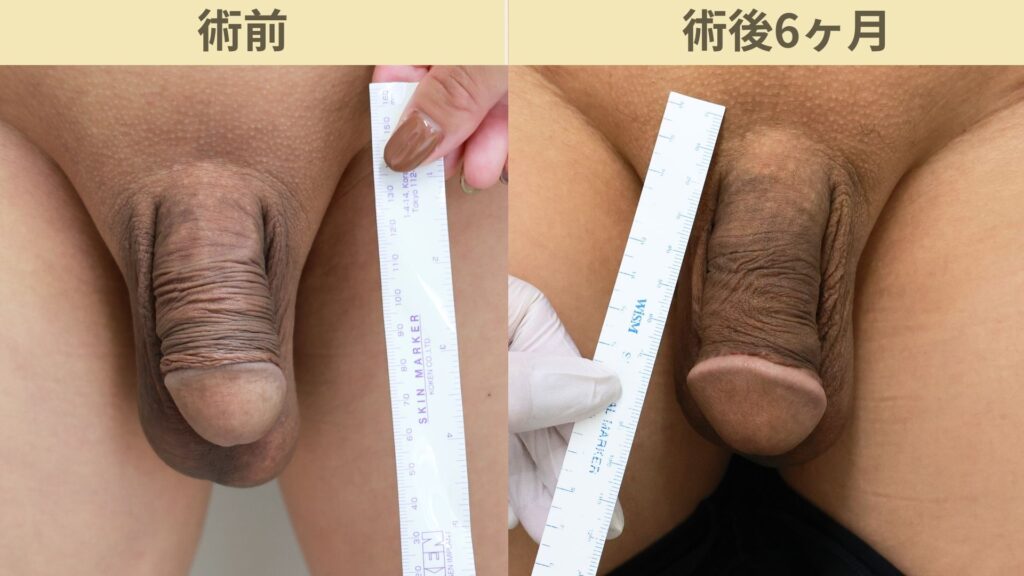 【症例41】30代男性 ｜アルモ式バック筋膜切開＋包茎で太さの拡大を重視術後6ヶ月