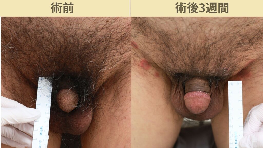 【症例43】60代男性 ｜アルモ式バック筋膜切開（靭帯剥離併用あり）＋包茎術＋他院修正で長茎15ｍｍ延長術後3週間3