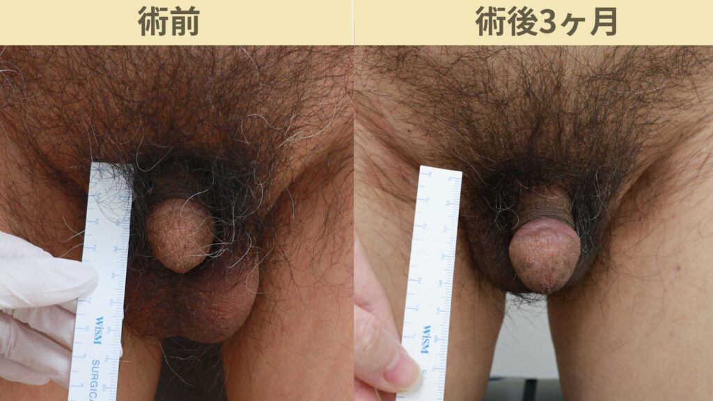 【症例43】60代男性 ｜アルモ式バック筋膜切開（靭帯剥離併用あり）＋包茎術＋他院修正で長茎15ｍｍ延長寿術後3ヶ月