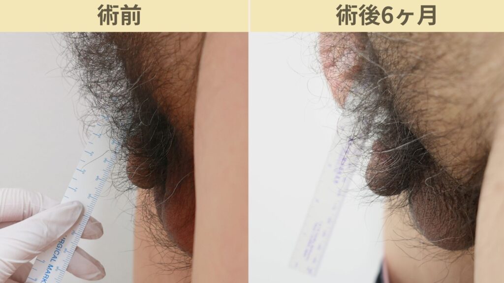 【症例43】60代男性 ｜アルモ式バック筋膜切開（靭帯剥離併用あり）＋包茎術＋他院修正で長茎15ｍｍ延長術後6ヶ月2