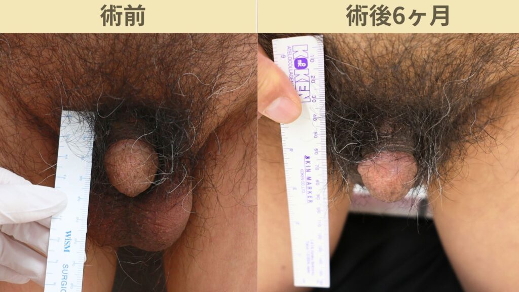 【症例43】60代男性 ｜アルモ式バック筋膜切開（靭帯剥離併用あり）＋包茎術＋他院修正で長茎15ｍｍ延長術後6ヶ月