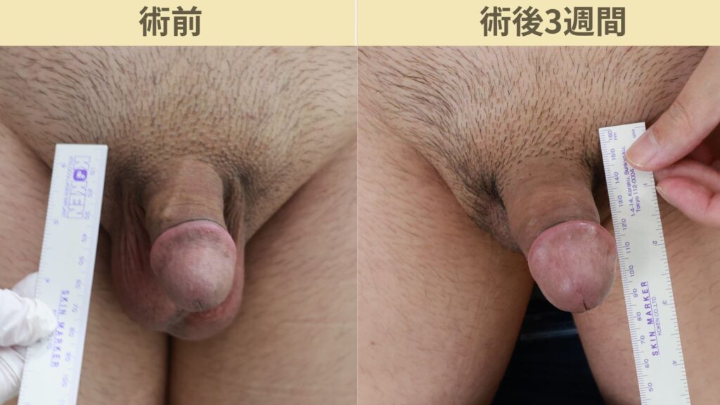 【症例47】30代男性 |アルモ式バック筋膜切開(靭帯剥離併用あり)+傷跡修正で長茎11mm延長術後3週間3