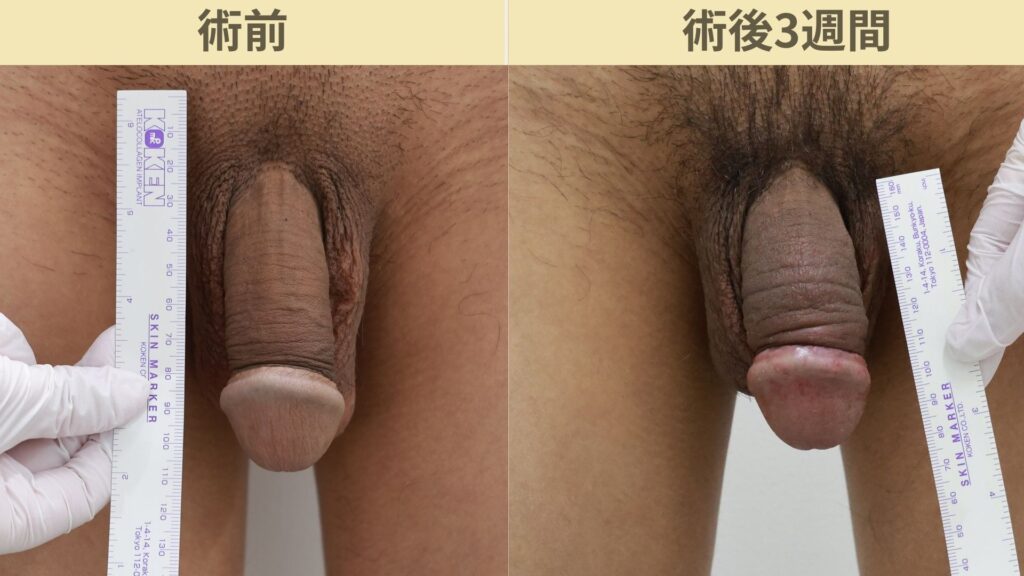 【症例51】20代男性 ｜アルモ式バック筋膜切開（靭帯剥離併用あり）＋他院修正で長茎12ｍｍ延長術後3週間3