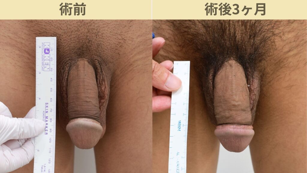 【症例51】20代男性 ｜アルモ式バック筋膜切開（靭帯剥離併用あり）＋他院修正で長茎12ｍｍ延長術後3ヶ月