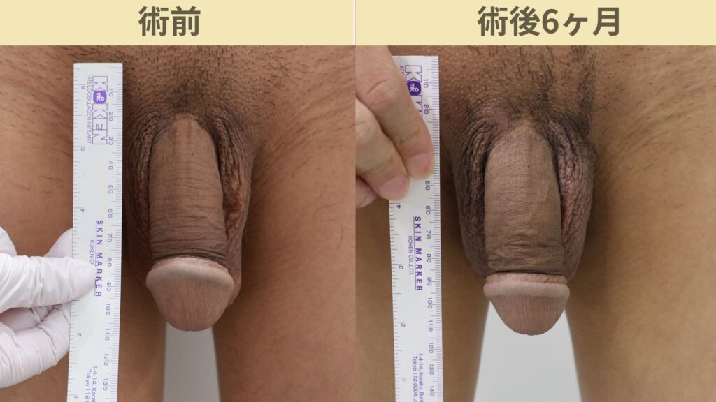 【症例51】20代男性 ｜アルモ式バック筋膜切開（靭帯剥離併用あり）＋他院修正で長茎12ｍｍ延長術後6ヶ月