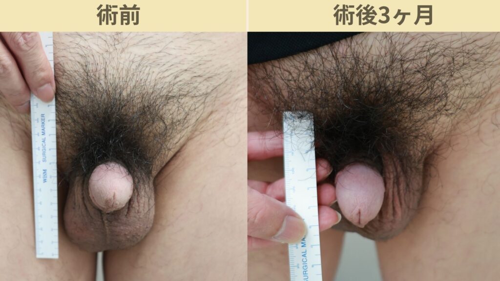 50代男性　バック筋膜切開＋靭帯剥離の術後3ヶ月