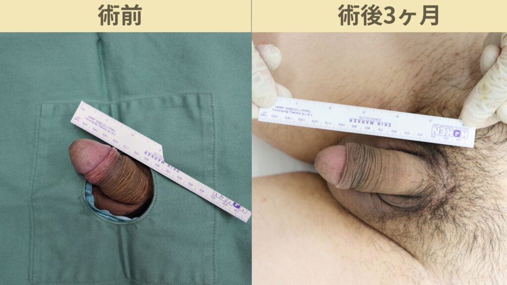 アルモ式バック筋膜切開、靭帯剥離(陰茎増大・長茎術)術後3ヶ月