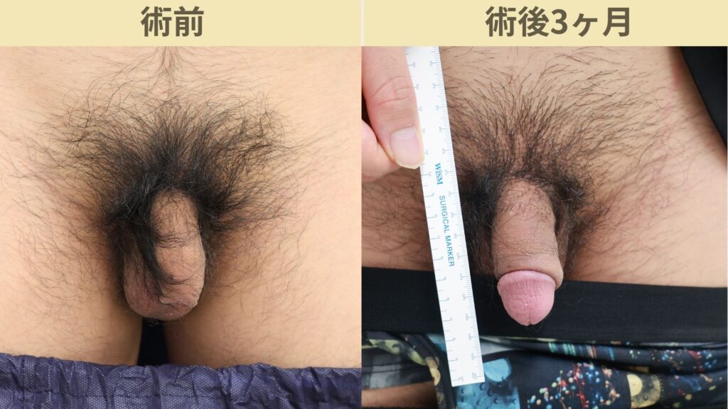 バック筋膜切開、靭帯剥離、瘢痕修正術術後3ヶ月