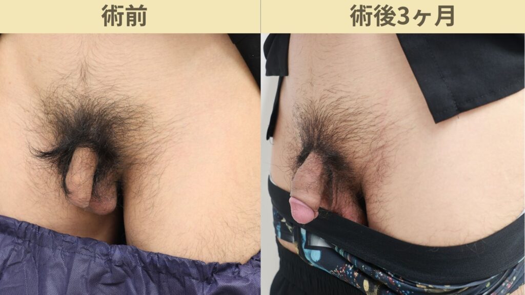 バック筋膜切開、靭帯剥離、瘢痕修正術術後3ヶ月2