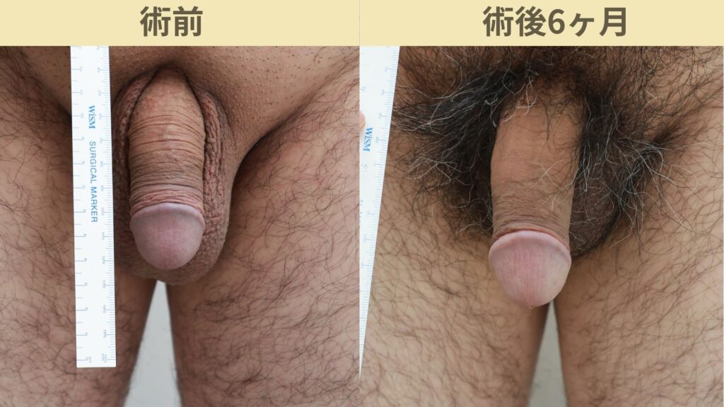 陰茎増大・長茎術術後6ヶ月