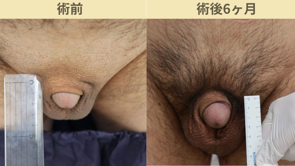 埋没陰茎術後6ヶ月
