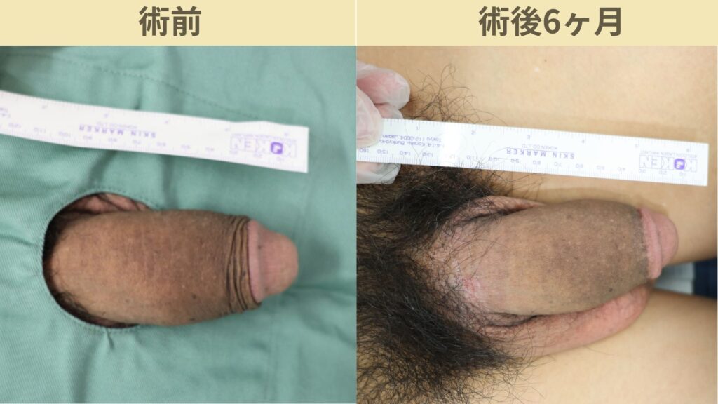 陰茎増大治療術6ヶ月