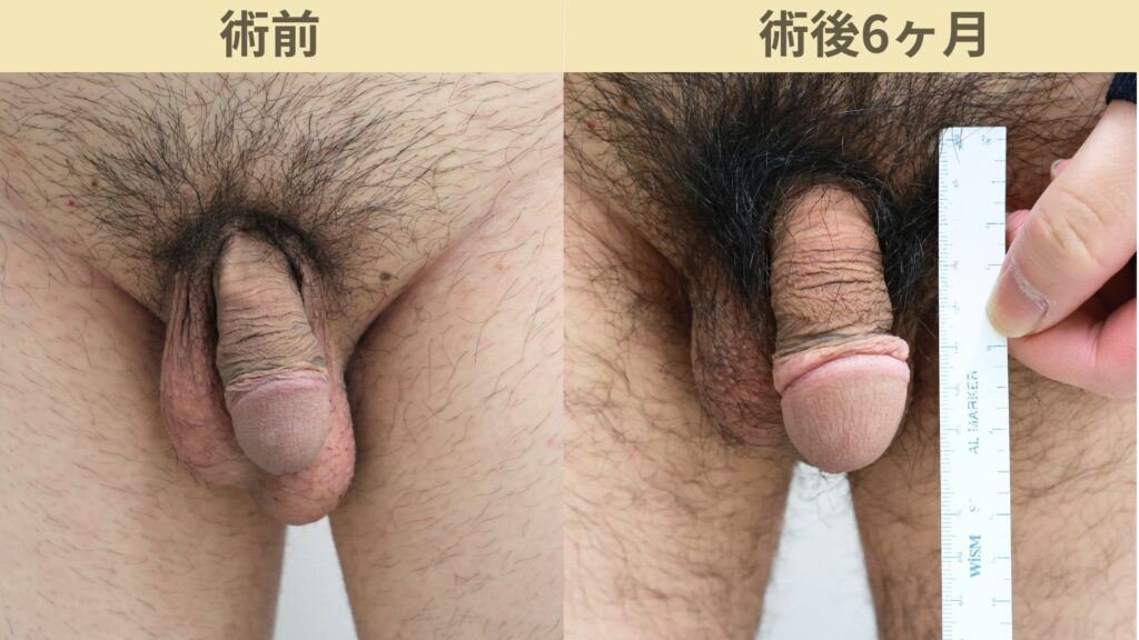 【症例26】30代男性 ｜アルモ式バック筋膜切開（靭帯剥離併用あり）＋包皮切除で長茎30ｍｍ延長術後6ヶ月