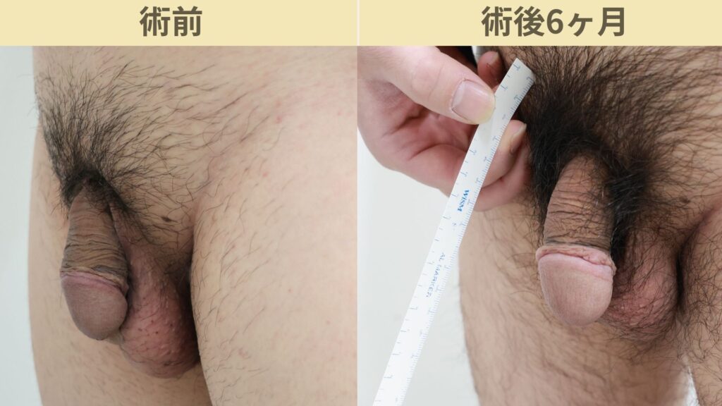 【症例26】30代男性 ｜アルモ式バック筋膜切開（靭帯剥離併用あり）＋包皮切除で長茎30ｍｍ延長術後6ヶ月2