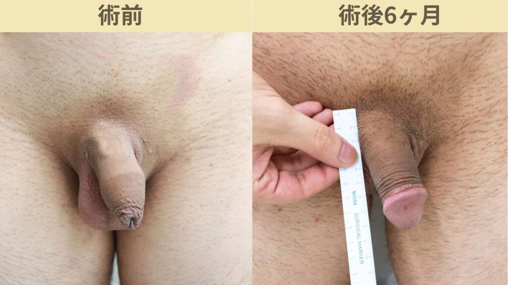 【症例27】20代男性 |アルモ式バック筋膜切開(靭帯剥離併用あり)+包皮切除で長茎21mm延長術後6ヶ月