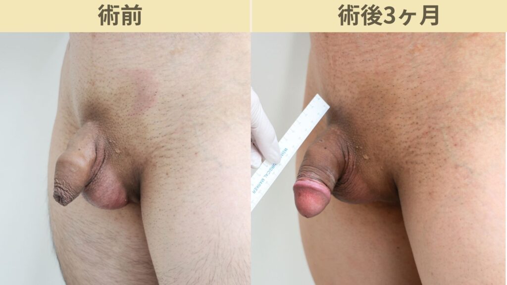 【症例27】20代男性 |アルモ式バック筋膜切開(靭帯剥離併用あり)+包皮切除で長茎21mm延長術後3ヶ月3