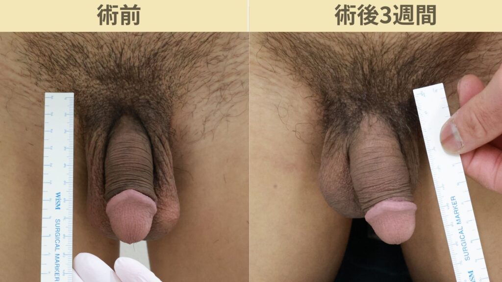 【症例49】20代男性 ｜アルモ式バック筋膜切開（靭帯剥離併用あり）＋他院修正で長茎10ｍｍ延長術後3週間3