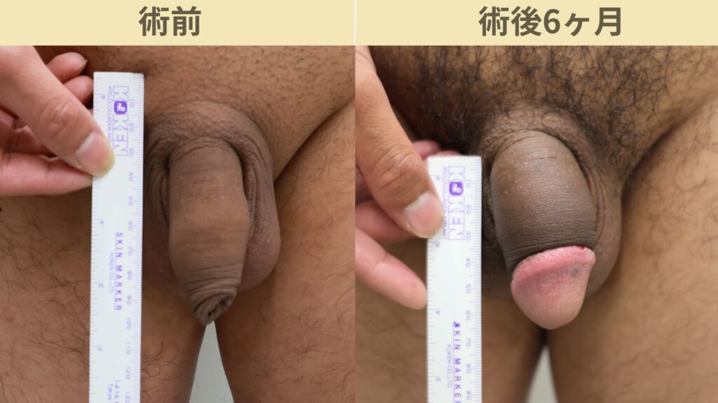 【症例56】20代男性 ｜アルモ式バック筋膜切開（靭帯剥離併用あり）＋包茎術で長茎25mm延長術後6ヶ月