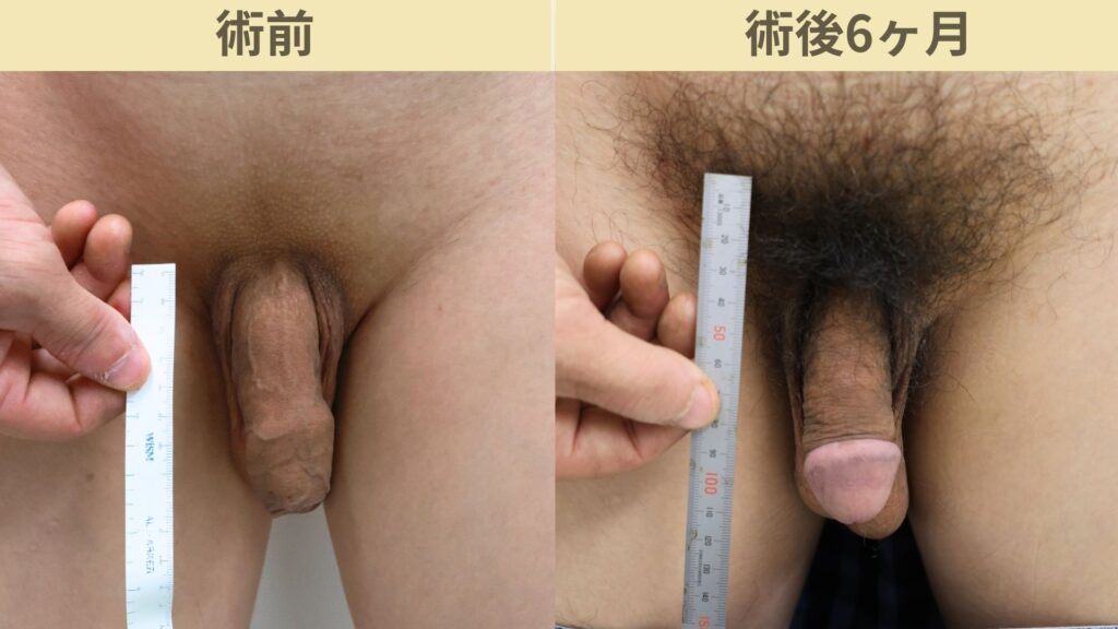 【症例58】30代男性 |アルモ式バック筋膜切開(靭帯剥離併用あり)+包茎術で長茎25mm延長術後6ヶ月