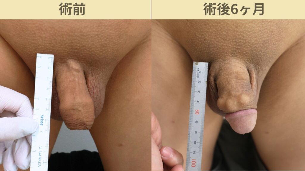 【症例54】40代男性 |アルモ式バック筋膜切開(靭帯剥離併用あり)+包茎術で長茎12mm延長術後6ヶ月